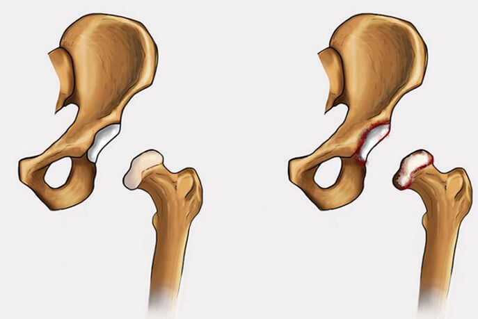 kalça ekleminde dejeneratif değişiklikler ve ağrı