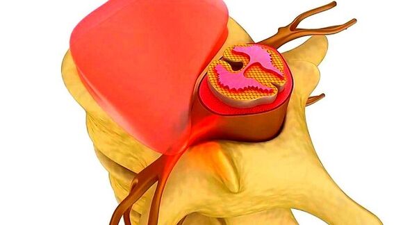Torasik omurganın osteokondrozu hastalığın özü