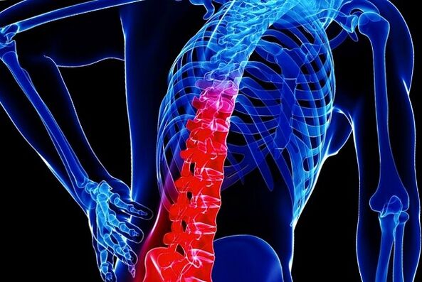 Torasik osteokondrozun gelişiminin nedenleri